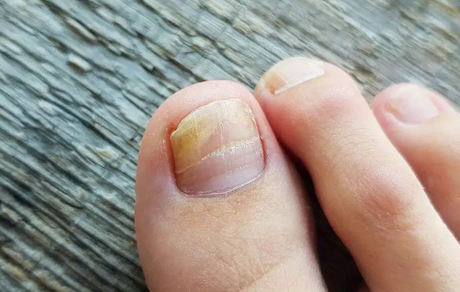 can nail fungus live in a nail polish bottle