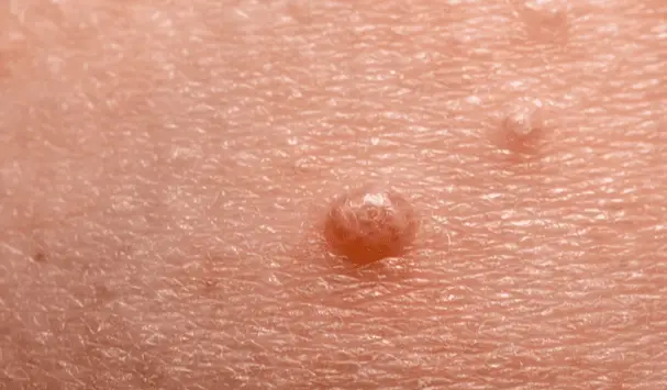 how long does molluscum contagiosum live on clothing
